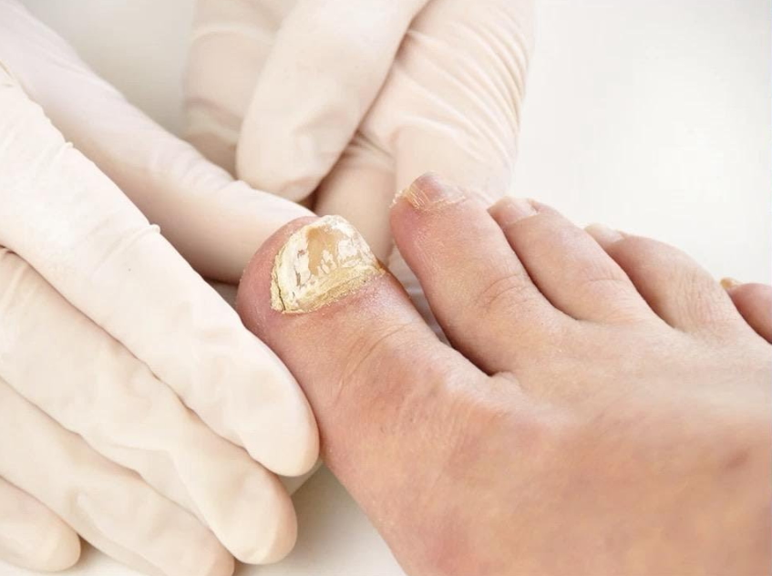 Toenail Fungus