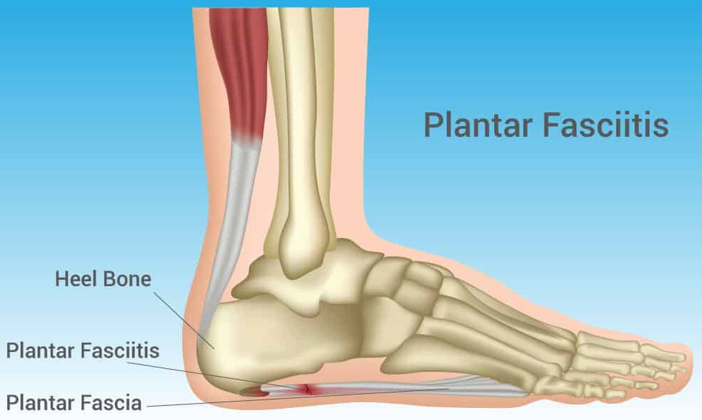 plantar fasciitis night splint